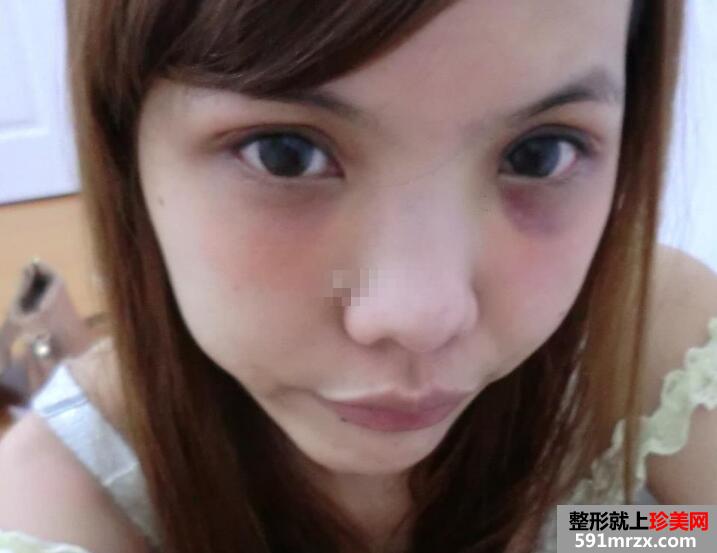 网红,养成记,套餐,价格,恢复,过程,前后,对比,效果图