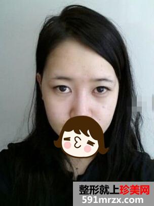 自体脂肪,隆鼻,恢复,过程,效果,对比图