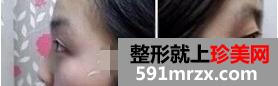 上海九院自体软骨移植隆鼻术恢复过程前后对比效果图