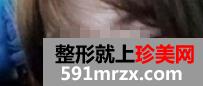 上海,九院,自体软骨,移植,隆鼻术,恢复,过程,前后,对比,效果图