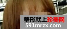 上海,九院,自体软骨,移植,隆鼻术,恢复,过程,前后,对比,效果图