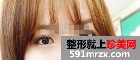 上海,九院,自体软骨,移植,隆鼻术,恢复,过程,前后,对比,效果图