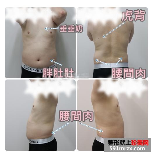 案例：全身吸脂手术过程及恢复前后效果对比图