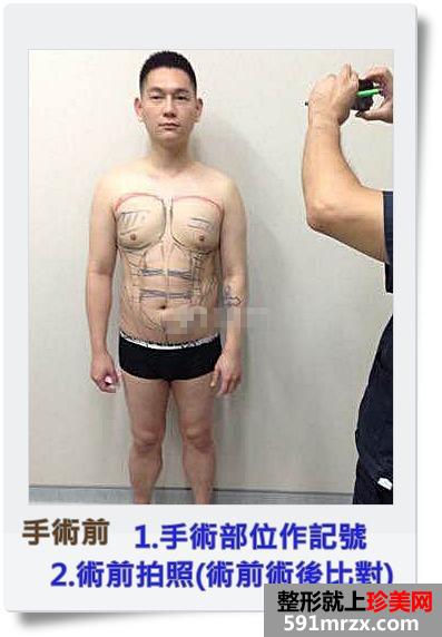 案例,全身,吸脂,手术,过程,前后,效果,对比图