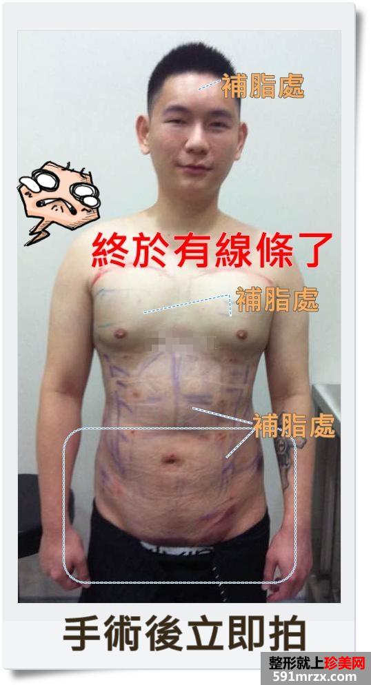 案例,全身,吸脂,手术,过程,前后,效果,对比图