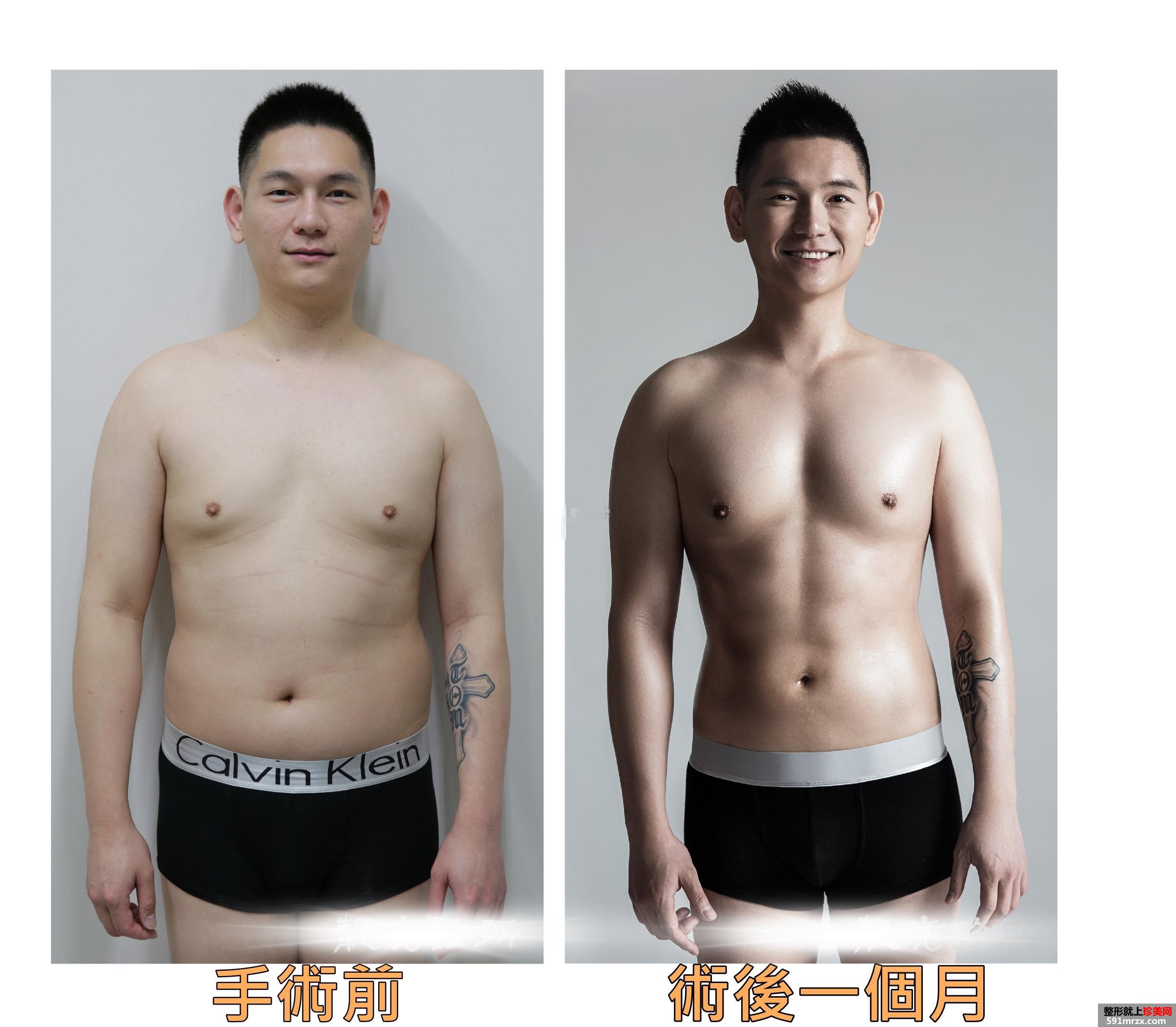 案例,全身,吸脂,手术,过程,前后,效果,对比图
