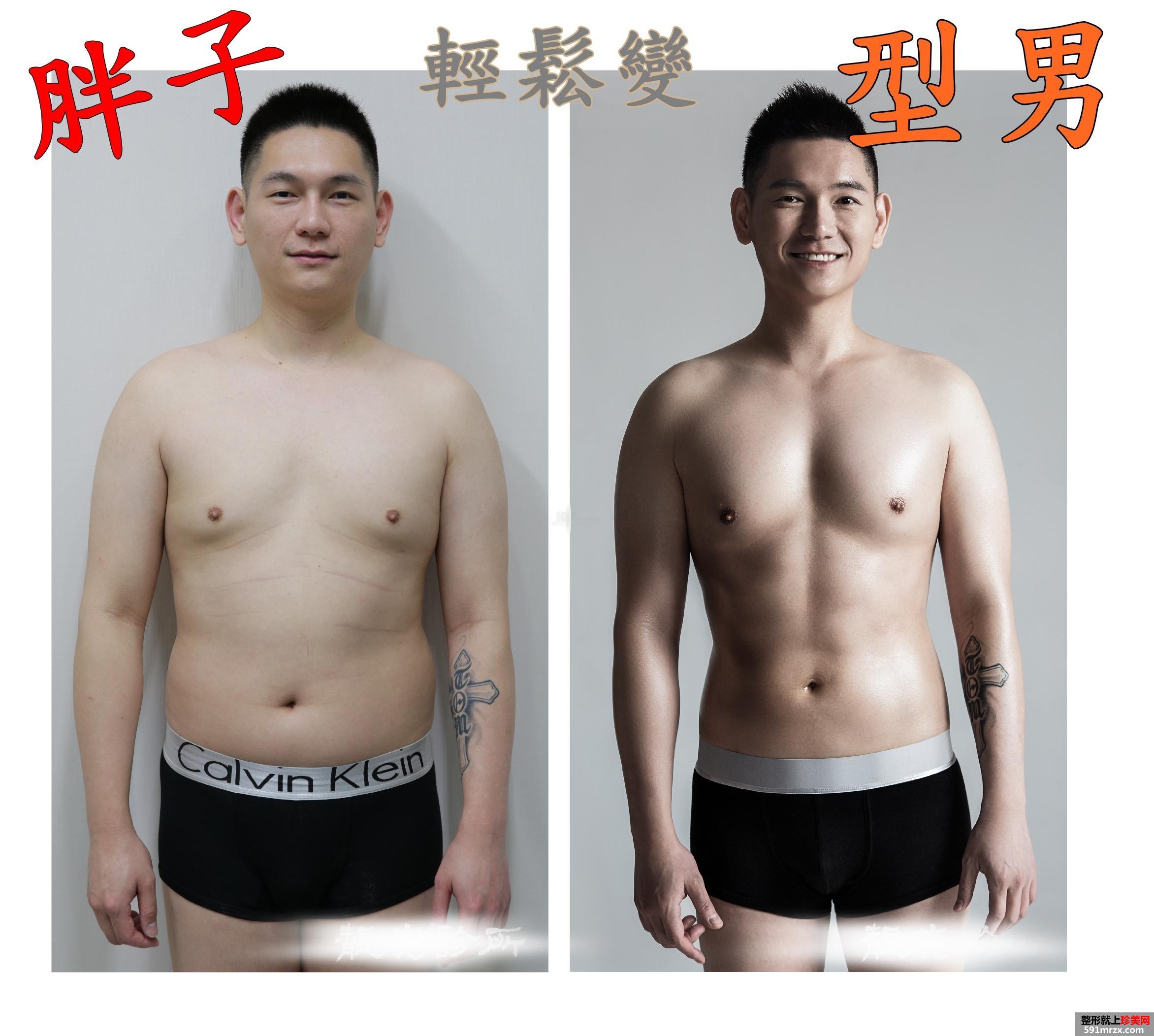 案例,全身,吸脂,手术,过程,前后,效果,对比图