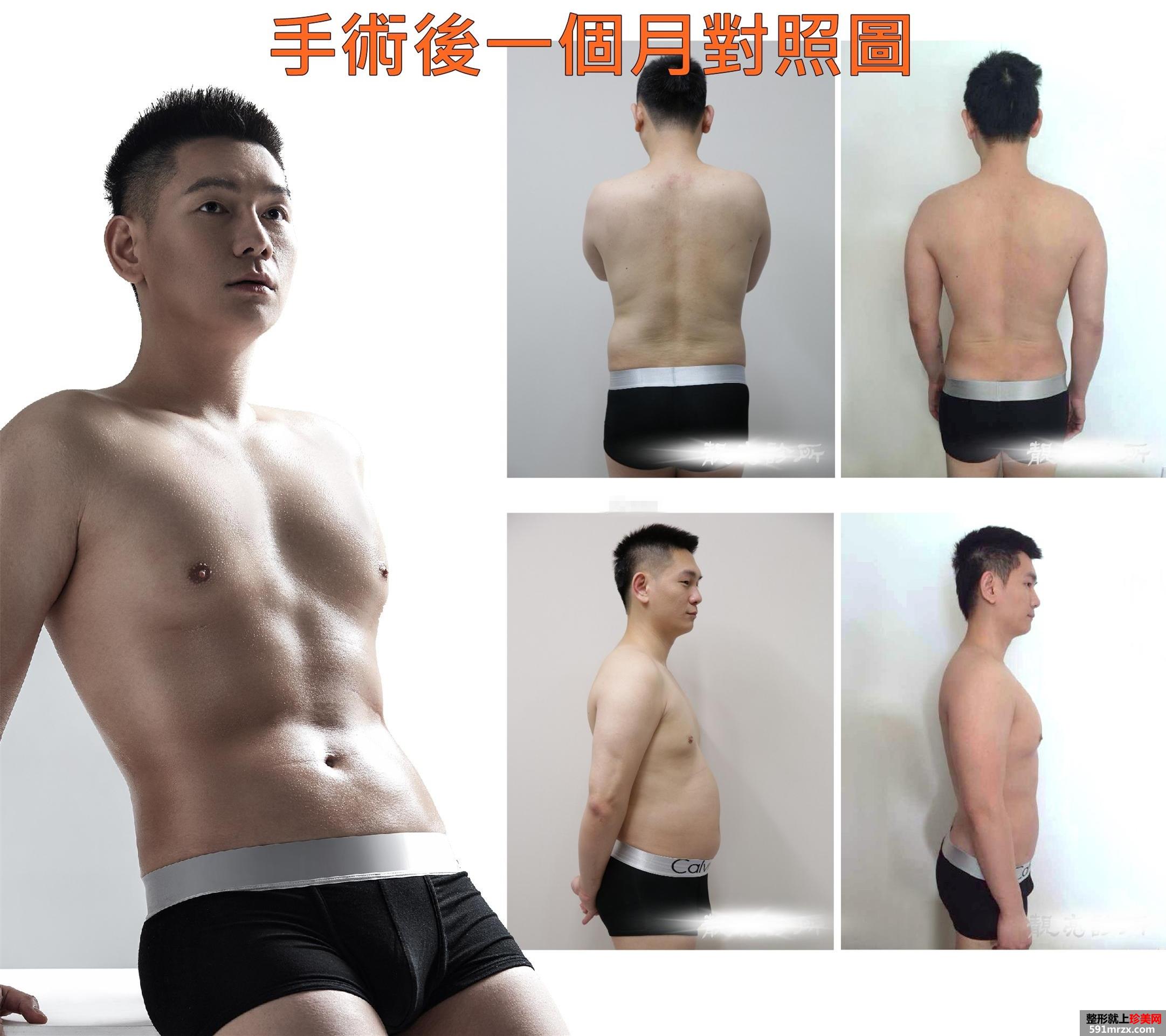 案例,全身,吸脂,手术,过程,前后,效果,对比图