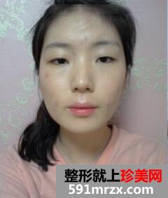 磨骨瘦脸手术多少钱？后遗症？前后对比图？真实案例？
