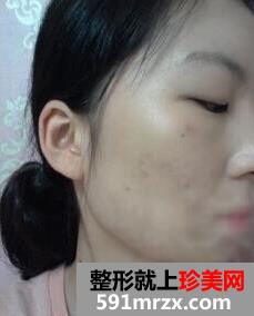 磨骨,瘦脸,手术,多少钱,后遗症,前后,对比图,真实案例