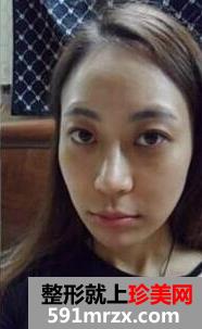 玻尿酸,注射,丰面颊,手术,恢复,过程,前后,对比,效果图