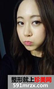 玻尿酸,注射,丰面颊,手术,恢复,过程,前后,对比,效果图