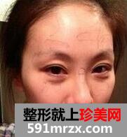 自体脂肪,移植,丰太阳穴,多少钱,手术,恢复,过程,前后,对比,效果图
