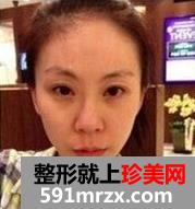自体脂肪,移植,丰太阳穴,多少钱,手术,恢复,过程,前后,对比,效果图