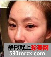 自体脂肪,移植,丰太阳穴,多少钱,手术,恢复,过程,前后,对比,效果图