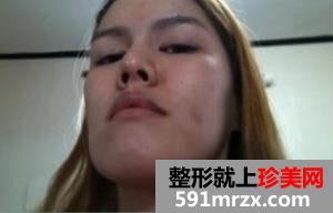 地包天整形手术恢复过程及前后对比效果图
