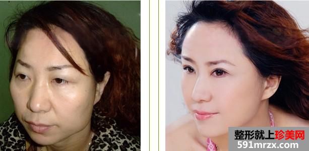 面部综合整形前后对比效果图片