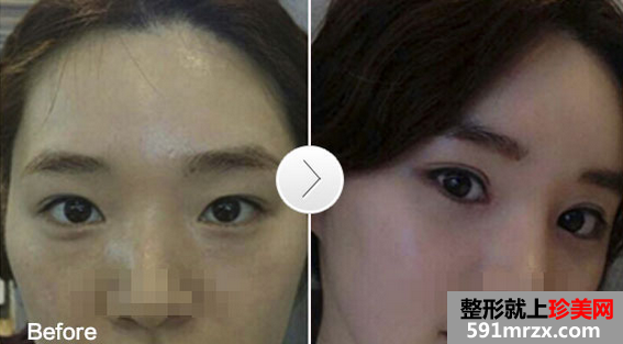 开内龇+重睑术前后对比效果图片和手术过程