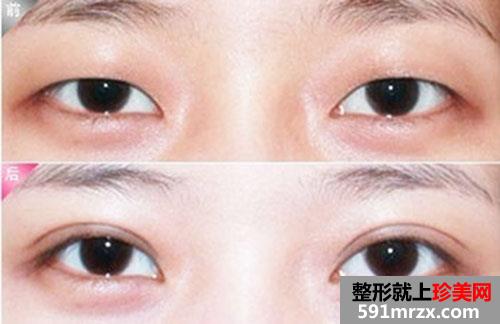 埋线法割双眼皮手术前后对比效果图片