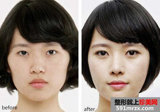 开眼角双眼皮手术前后对比效果图片