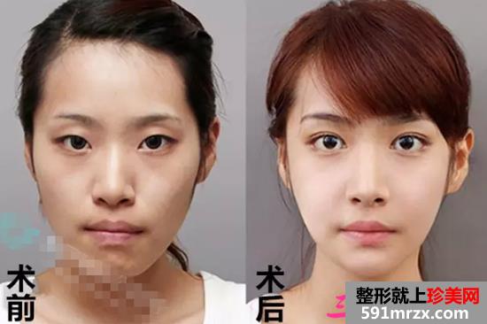 欧式芭比双眼皮前后对比效果图片