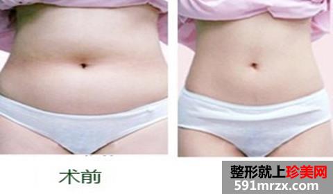 360度,环状,立体,吸脂,前后,对比,效果,图片