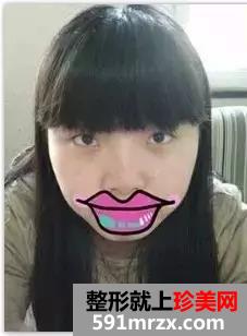 韩式双眼皮+无痕开眼角前后对比效果图片和恢复过程