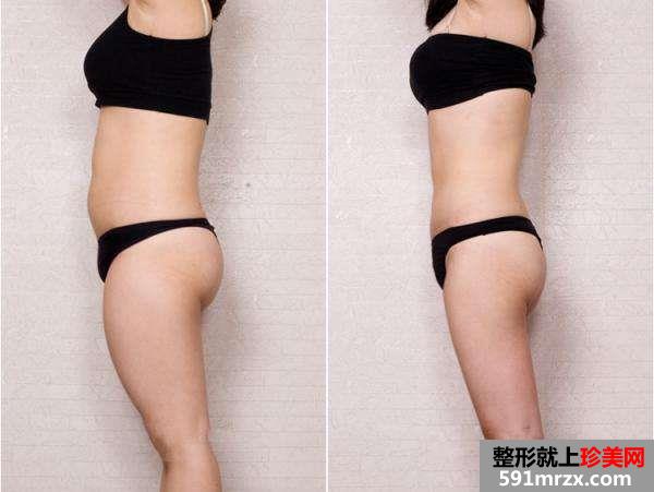 北京吸脂多少钱