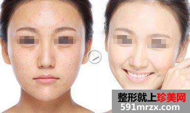 复合彩光嫩肤祛斑前后对比效果图片和恢复过程