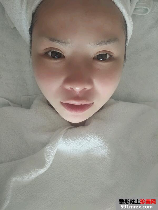 微晶磨皮手术去红血丝祛痘前后对比效果图片跟恢复过程分享