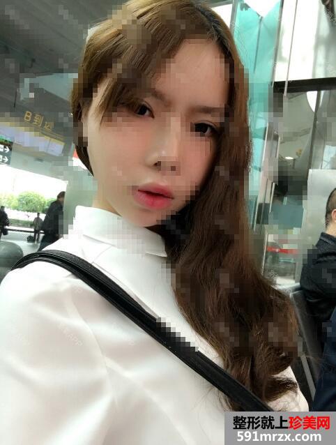 微晶磨皮手术去红血丝祛痘前后对比效果图片跟恢复过程分享