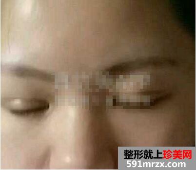 埋线去肿眼泡手术前后对比效果照片和恢复过程真实经历