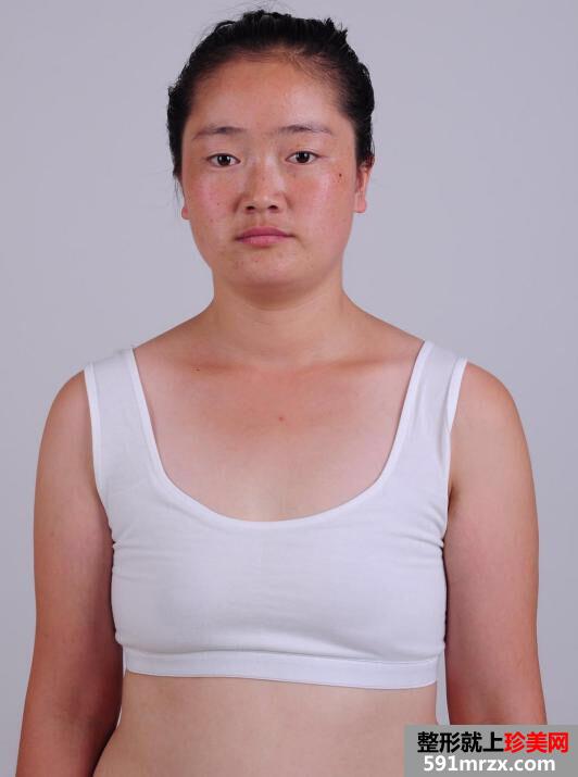 硅胶假体植入隆鼻手术恢复过程分享，还有前后对比效果图片哦!