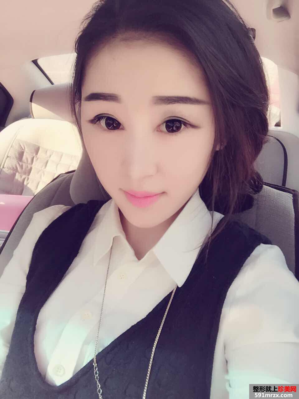 美女做玻尿酸丰苹果肌手术前后对比效果图片恢复过程分享