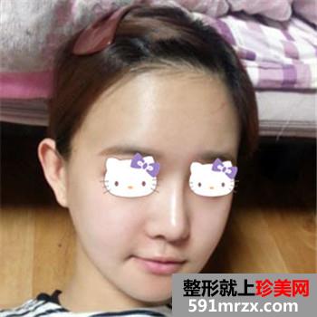 磨腮削骨手术
