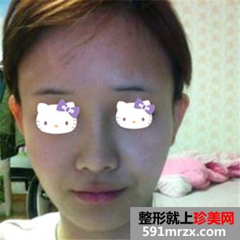 磨腮削骨手术