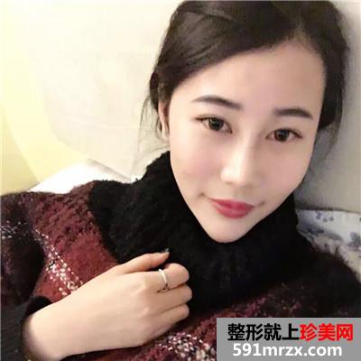 切开割双眼皮手术一个月恢复过程分享，还有大量前后对比图哦~