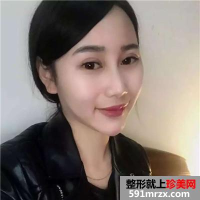 切开割双眼皮手术一个月恢复过程分享，还有大量前后对比图哦~