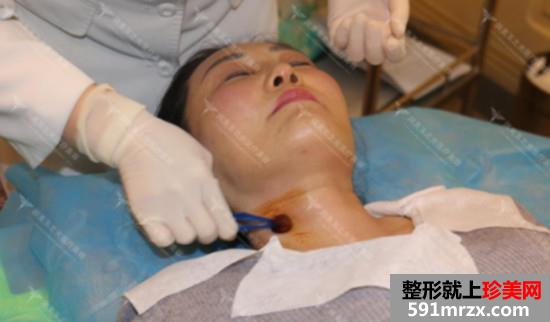 注射玻尿酸去颈纹效果怎么样？安全吗？看看我的前后对比效果图片~