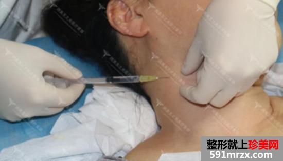 注射玻尿酸去颈纹效果怎么样？安全吗？看看我的前后对比效果图片~