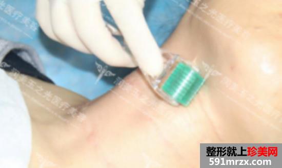 注射玻尿酸去颈纹效果怎么样？安全吗？看看我的前后对比效果图片~