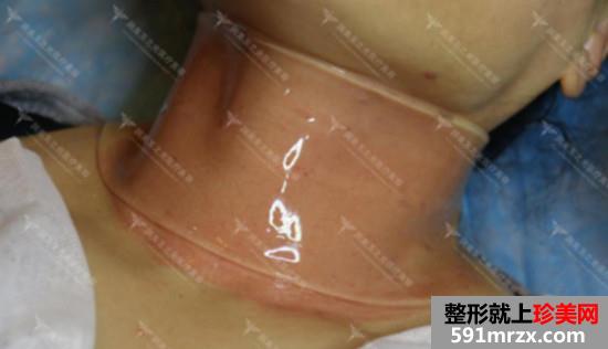 注射玻尿酸去颈纹效果怎么样？安全吗？看看我的前后对比效果图片~