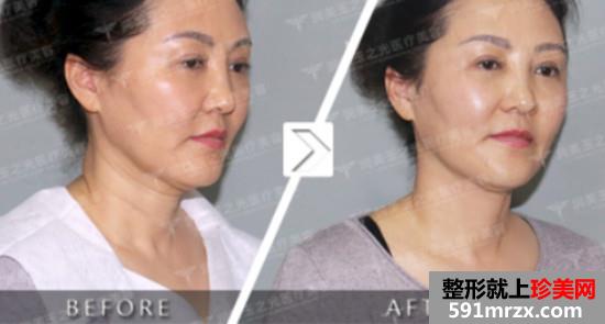 注射玻尿酸去颈纹效果怎么样？安全吗？看看我的前后对比效果图片~