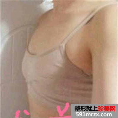 水滴形隆胸怎么样？看看我的前后对比效果图片就知道了~