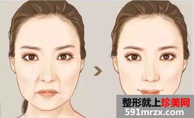 北京做自体脂肪丰鼻唇沟大概要多少钱？