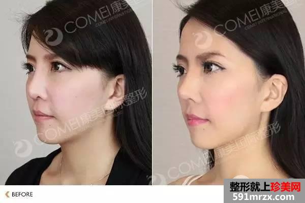 假体隆鼻,失败修复