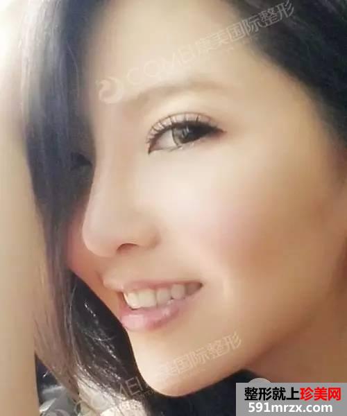 假体隆鼻,失败修复