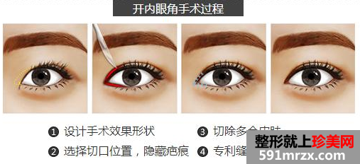 开内眼角手术过程，开眼角有哪些方式，开眼角多少钱？