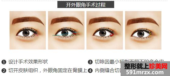 开外眼角手术过程，开眼角需要多少钱，开眼角有哪些有点