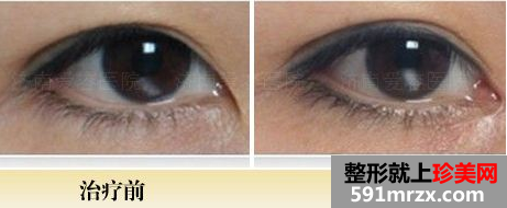 开眼角对比图，哪些眼睛适合开眼角